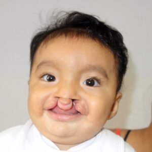 Smiling baby boy with a cleft lip