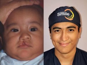 A baby boy with cleft lip and his photo after 20 years of comprehensive cleft care
