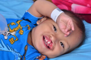 Smiling baby with cleft lip