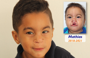 Young boy with severe cleft lip before and after undergoing an innovative surgical technique