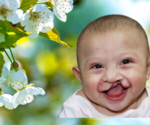 Smiling baby with cleft lip against a floral backdrop
