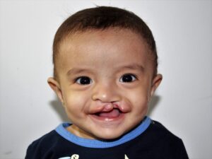 Smiling little boy with a cleft lip