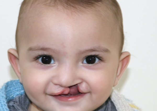 Baby boy with a cleft lip