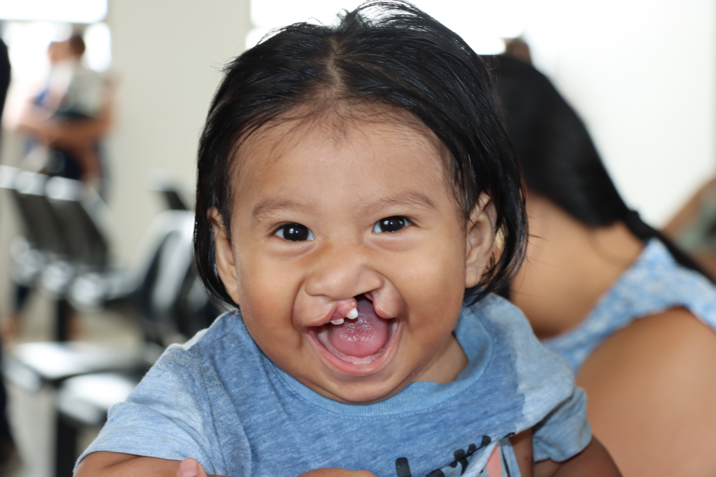 A toddler boy with a cleft lip and a big smile