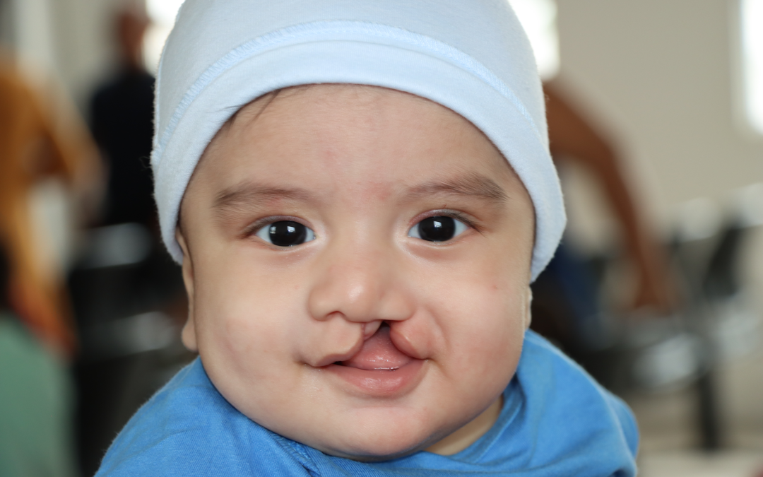 Providing cleft care in Ecuador