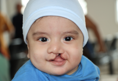 Baby with cleft lip
